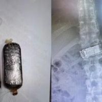 Preso engole celular e precisa passar por cirurgia