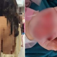 Madrasta que queimou mão de enteada é presa em Itapema