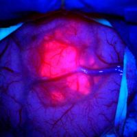 Tecnologia faz tumor “brilhar” e transforma neurocirurgias em hospital de BC