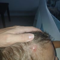 Médicos do CIS não conseguem diagnosticar berne em cabeça de bebê