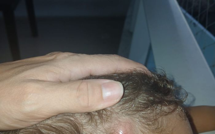 Criança de dois anos só conseguiu tirar o berne mais de 20 dias depois, na UPA de Balneário